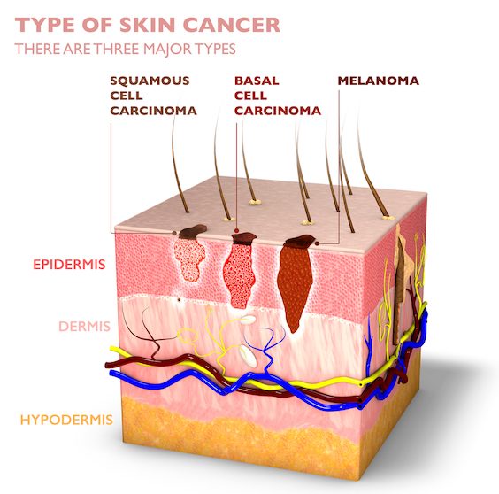 Type of Skin Cancer