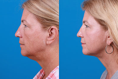 Nonsurgical face-lift