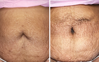 Pictures of Stewart's stomach before her procedure, left, and after, right, reveal a significant loss of unwanted fat. With liposuction, BodyTite, diet and exercise, Stewart was able to lose 20 pounds.